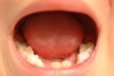乳歯は歯垢がたまりやすい