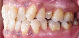 歯周病の危険信号